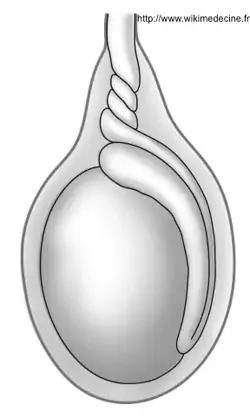 Torsion testiculaire intravaginale