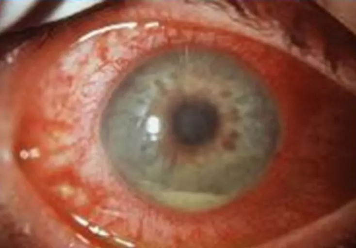 Uvéite antérieure - oeil rouge avec hypopion