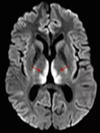 Encéphalopathie de Wernicke - IRM cérébrale - Diffusion - Hypersignaux bithalamiques
