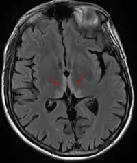 Encéphalopathie de Wernicke - IRM cérébrale - FLAIR - Hypersignaux bithalamiques