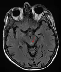 Encéphalopathie de Wernicke - IRM cérébrale - FLAIR - Hypersignal péri-aqueducal